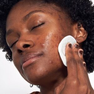 Acne Treatment