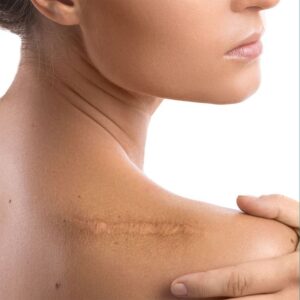 Scar Care